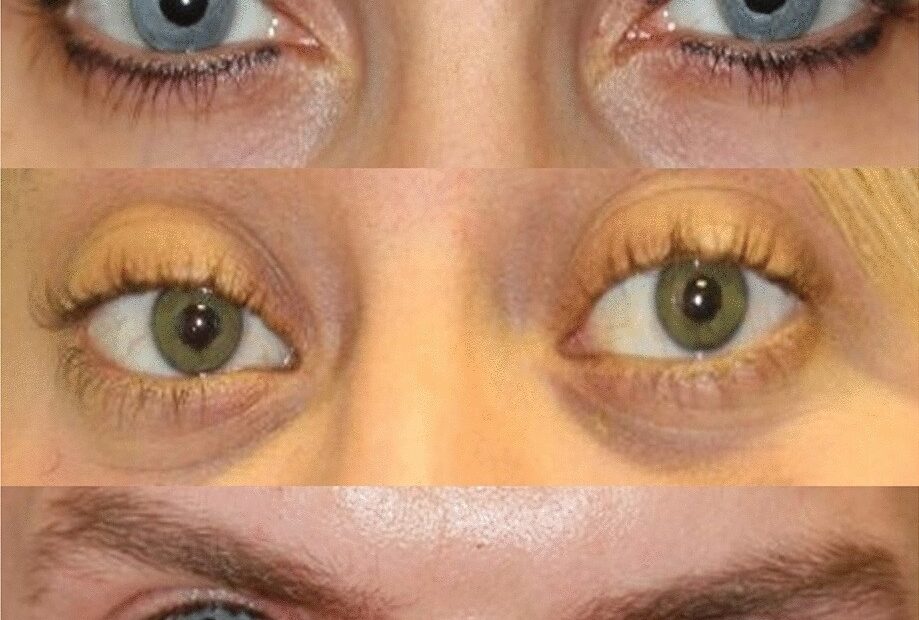 Cosmetic Change Of The Apparent Color Of The Eye A Review On Surgical Alternatives Outcomes And Complications Ophthalmology And Therapy