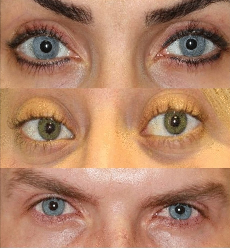 Cosmetic Change Of The Apparent Color Of The Eye A Review On Surgical Alternatives Outcomes And Complications Ophthalmology And Therapy