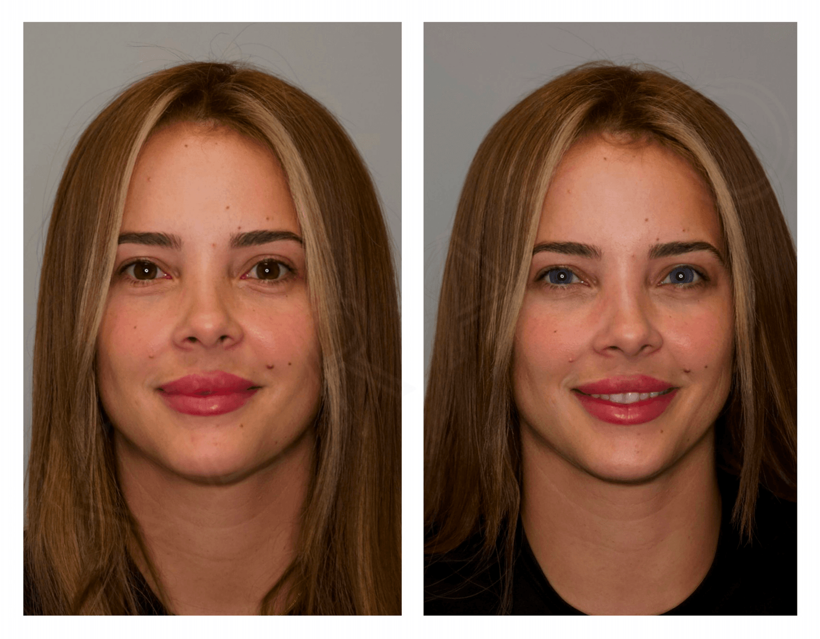 How Keratopigmentation Permanently Changes Your Eye Color Allure