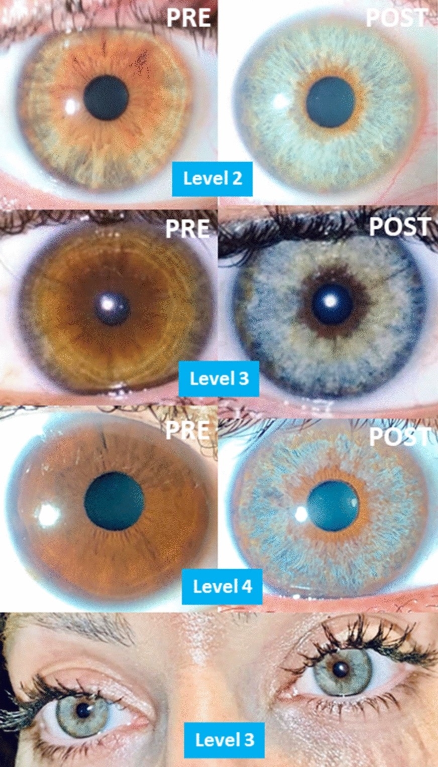 Photoablative Cosmetic Iridoplasty Effective Safe And Predictable eye Color Change In 1176 Eyes International Ophthalmology
